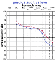 mild hearing loss audiogram