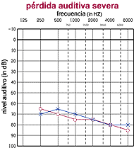 severe hearing loss audiogram