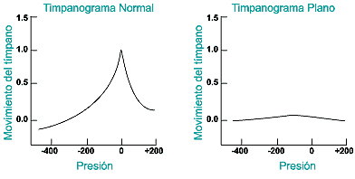 tympanograms