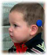 child with cochlear implant